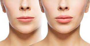 Discovering Beauty: Lip Fillers in Hoboken post thumbnail image